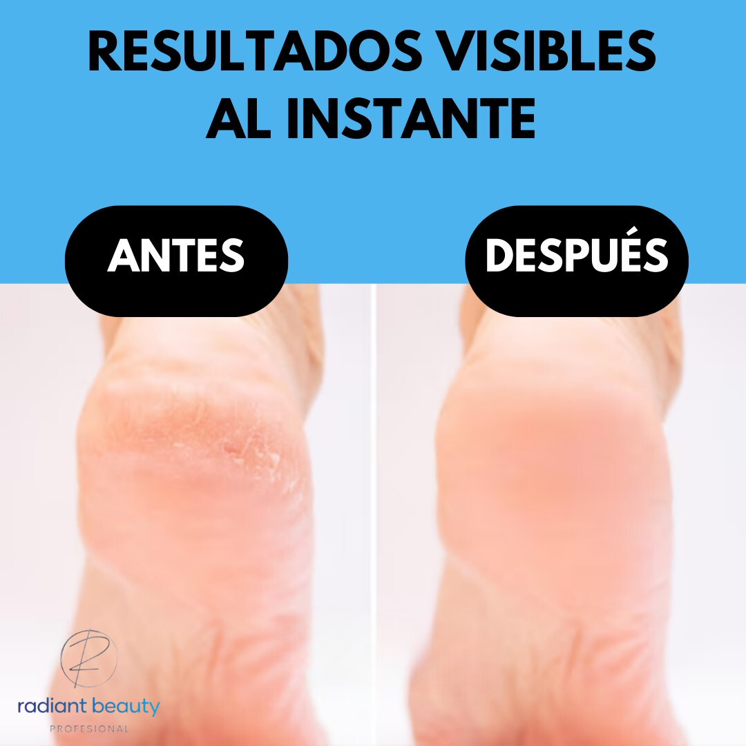 Elimina callos PerfectFeet™ - Olvídate de los callos.